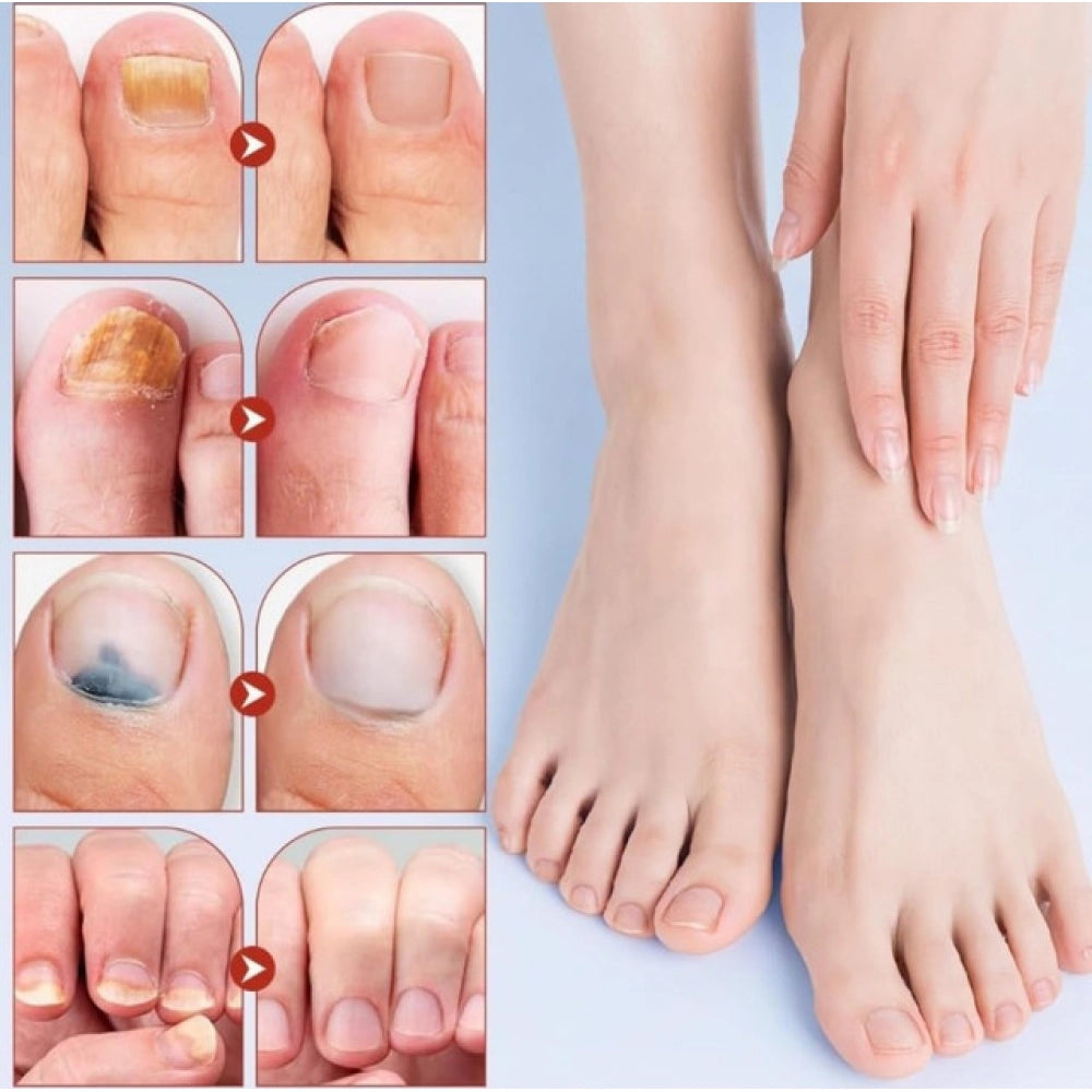 Fungal Nail Patches (Yellow)